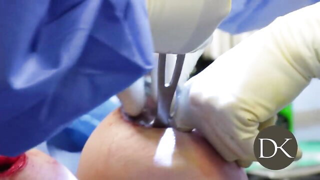 Surgeons performing large breast augmentation surgery, explicit nudity