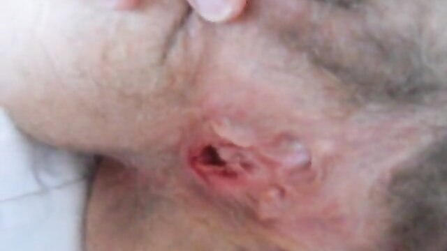 Closeup of mature man's infected ear wound with pus and scabs
