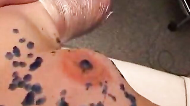 Christine's breast tortured with bruises and welts in extreme BDSM