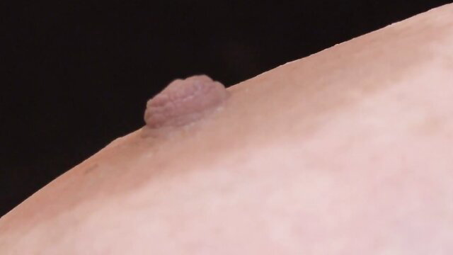 Closeup of pink skin tag bump on pale smooth skin in BBW legend video